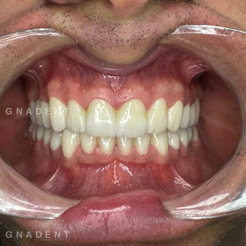 Desgaste por bruxismo | GNADENT. Clínica Dental Valencia