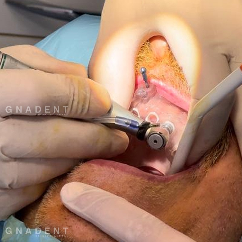 Implantes Dentales | GNADENT. Clínica Dental Valencia