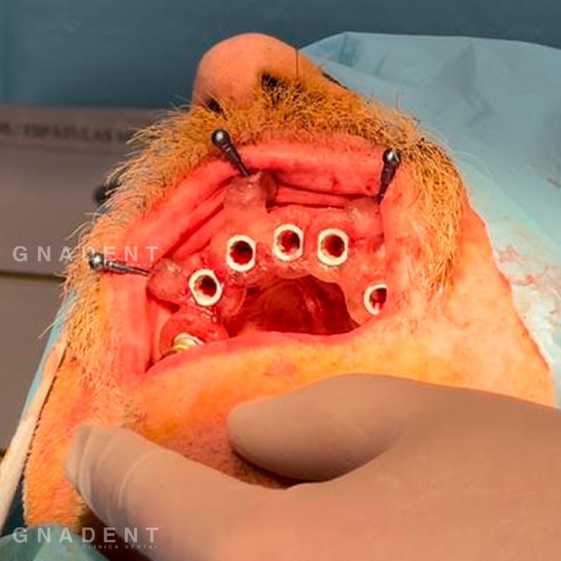 Implantes Dentales | GNADENT. Clínica Dental Valencia