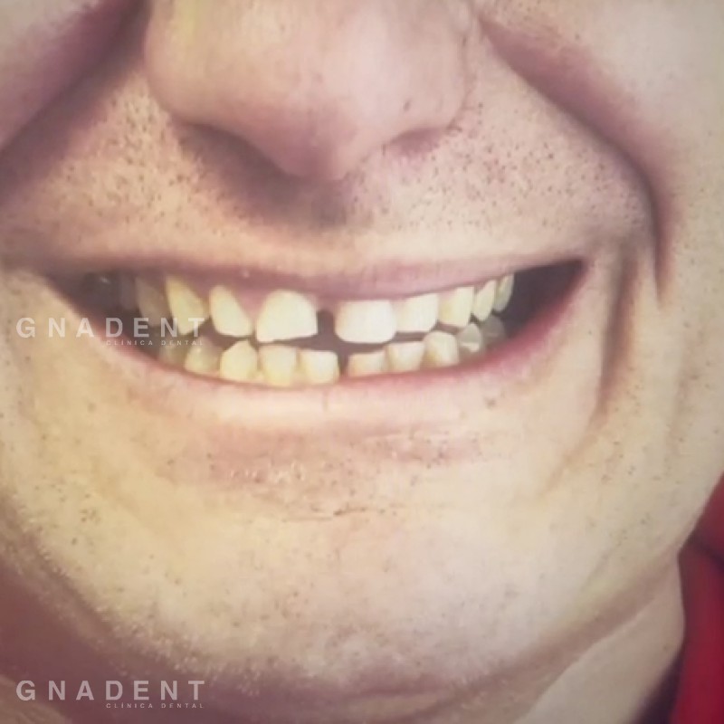 Desgaste por bruxismo | GNADENT. Clínica Dental Valencia