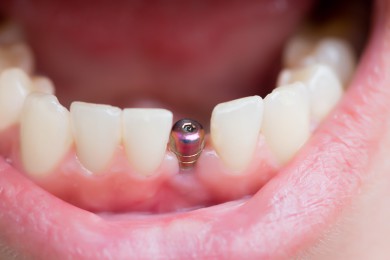 implantes dentales en valencia. Implantes dentales | Especialidades y tratamientos dentales en Valencia');