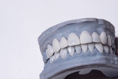 protesis dental valencia. Prótesis dental | Especialidades y tratamientos dentales en Valencia');