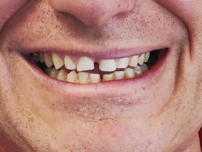 Antes — Rehabilitación con Coronas Cerámicas Gnadent Valencia