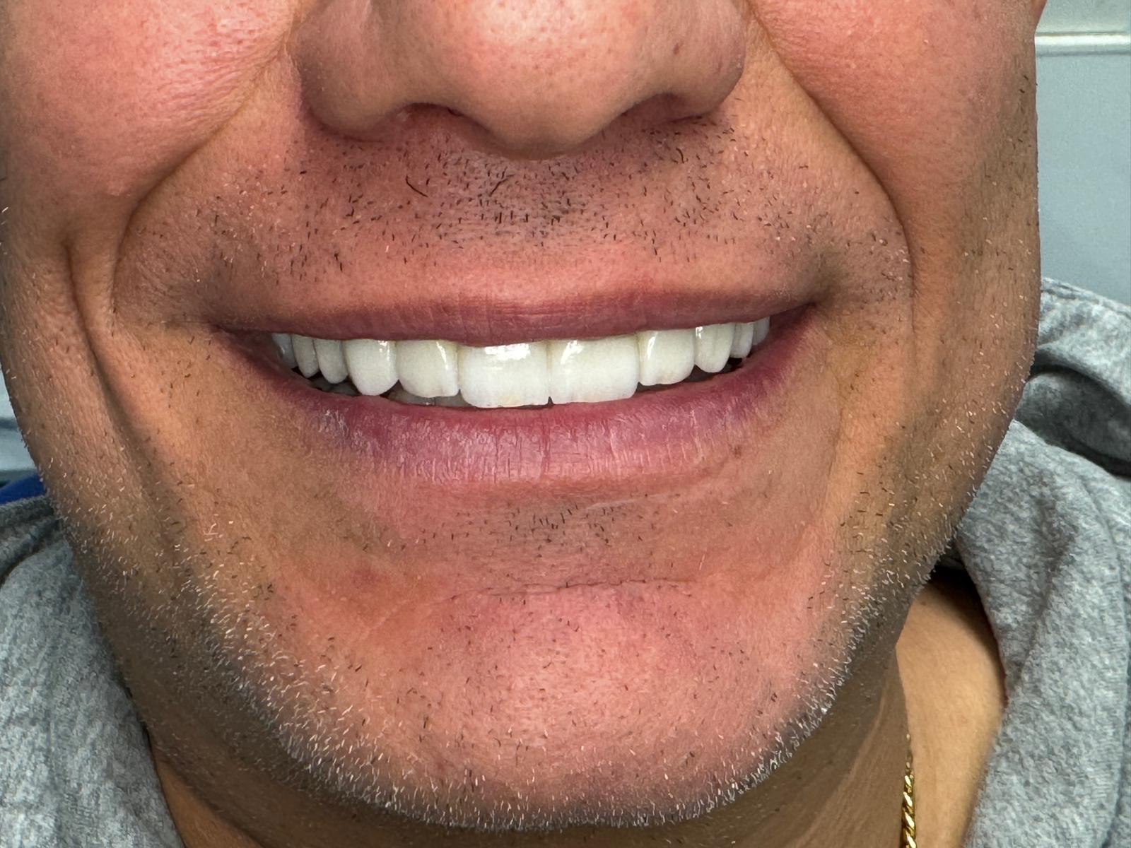 Después — Resultado Real Coronas Cerámicas Gnadent Valencia