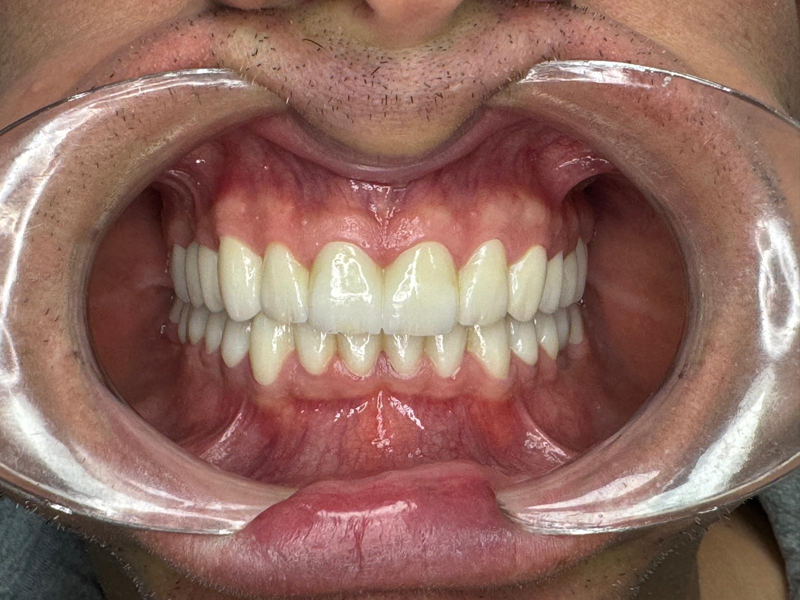 Vista frontal coronas cerámicas — Gnadent