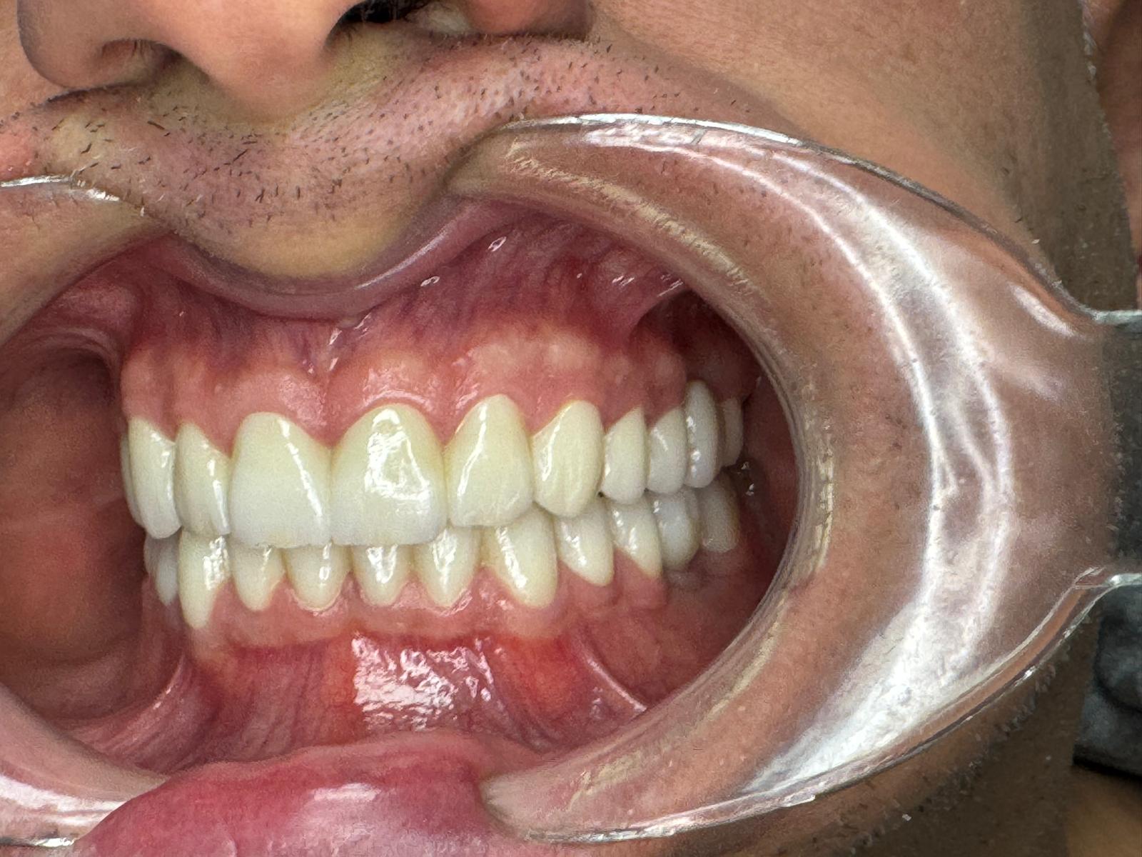 Vista lateral derecha coronas — Gnadent