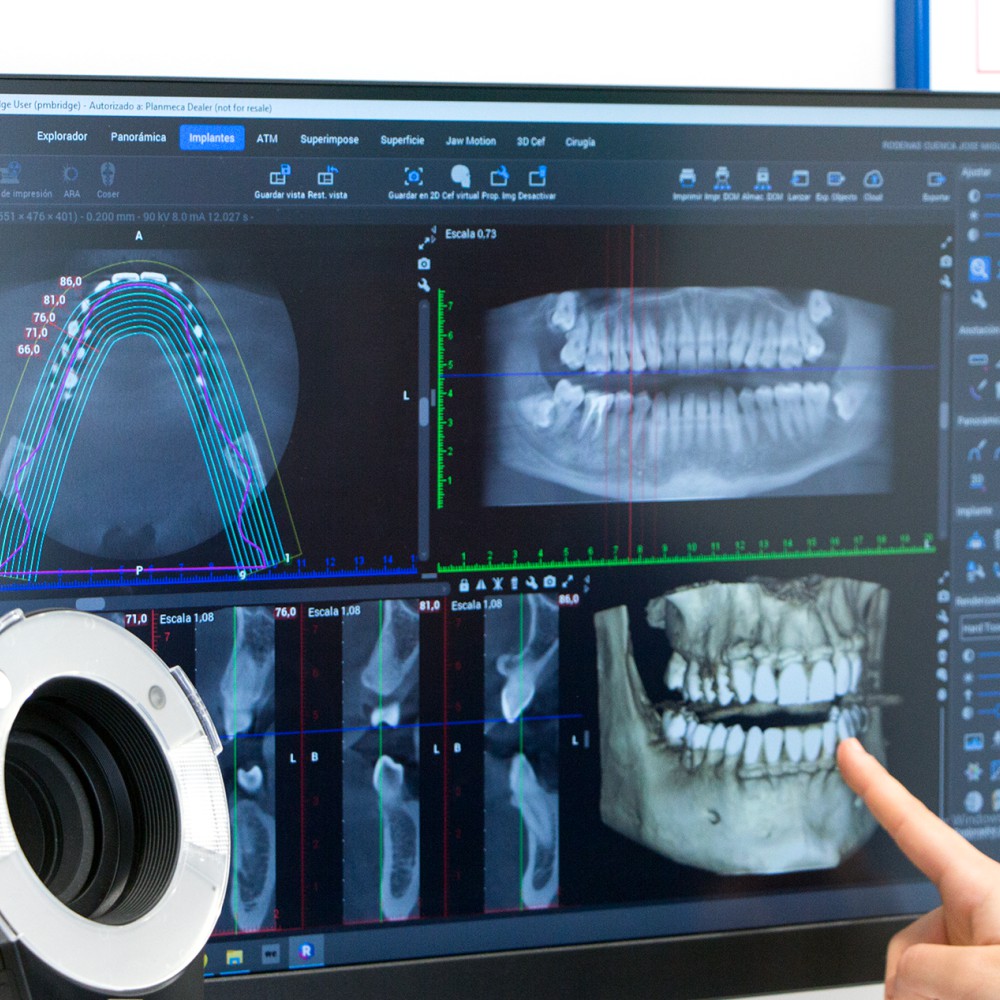 TAC Dental Planificación 3D
