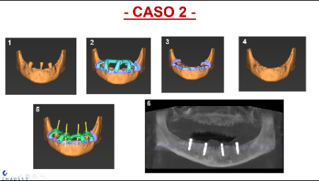 Planificación Digital de Implantes