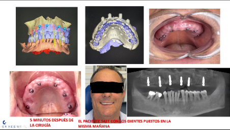 Colocación de Dientes Provisionales Inmediatos