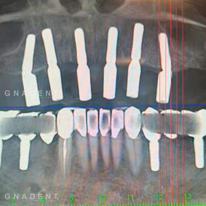 TAC Post-implantes Verificación 3D